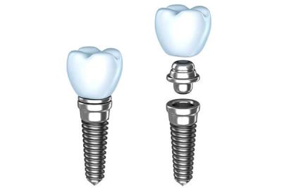 dental-implants-illustration